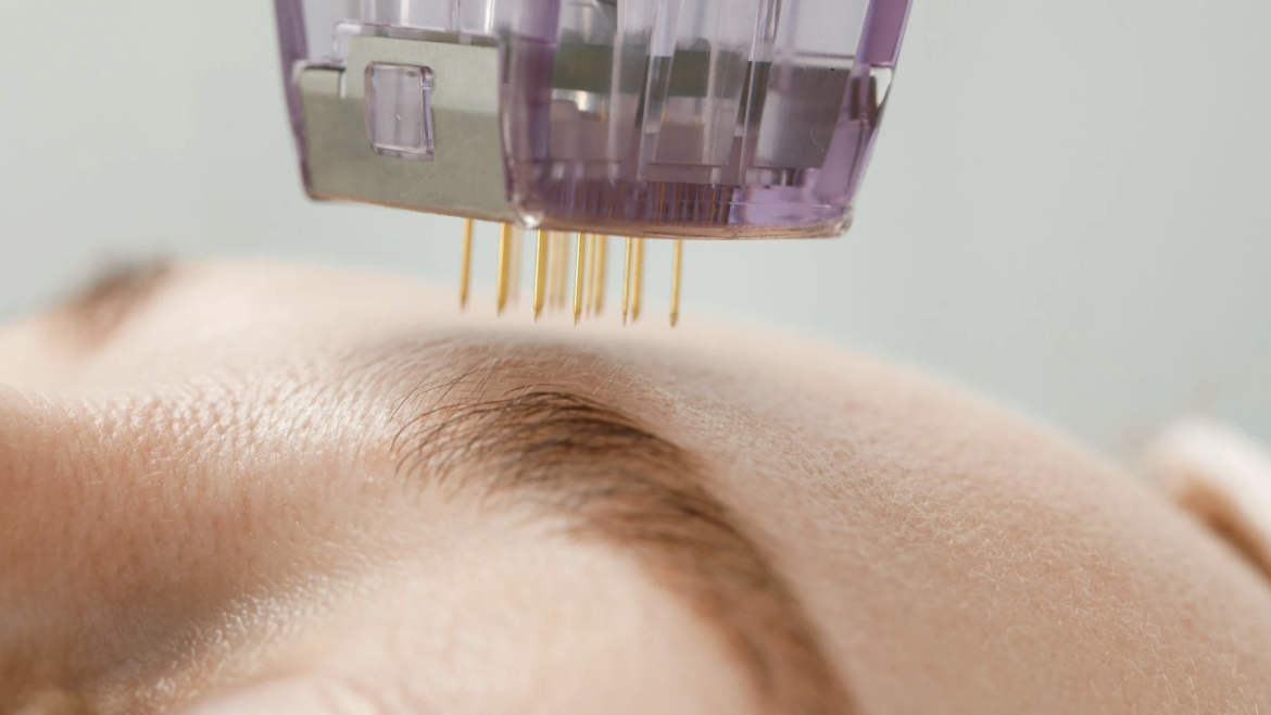 Microneedling and PRP Facial Appointment Pricing in Arlington, Virginia